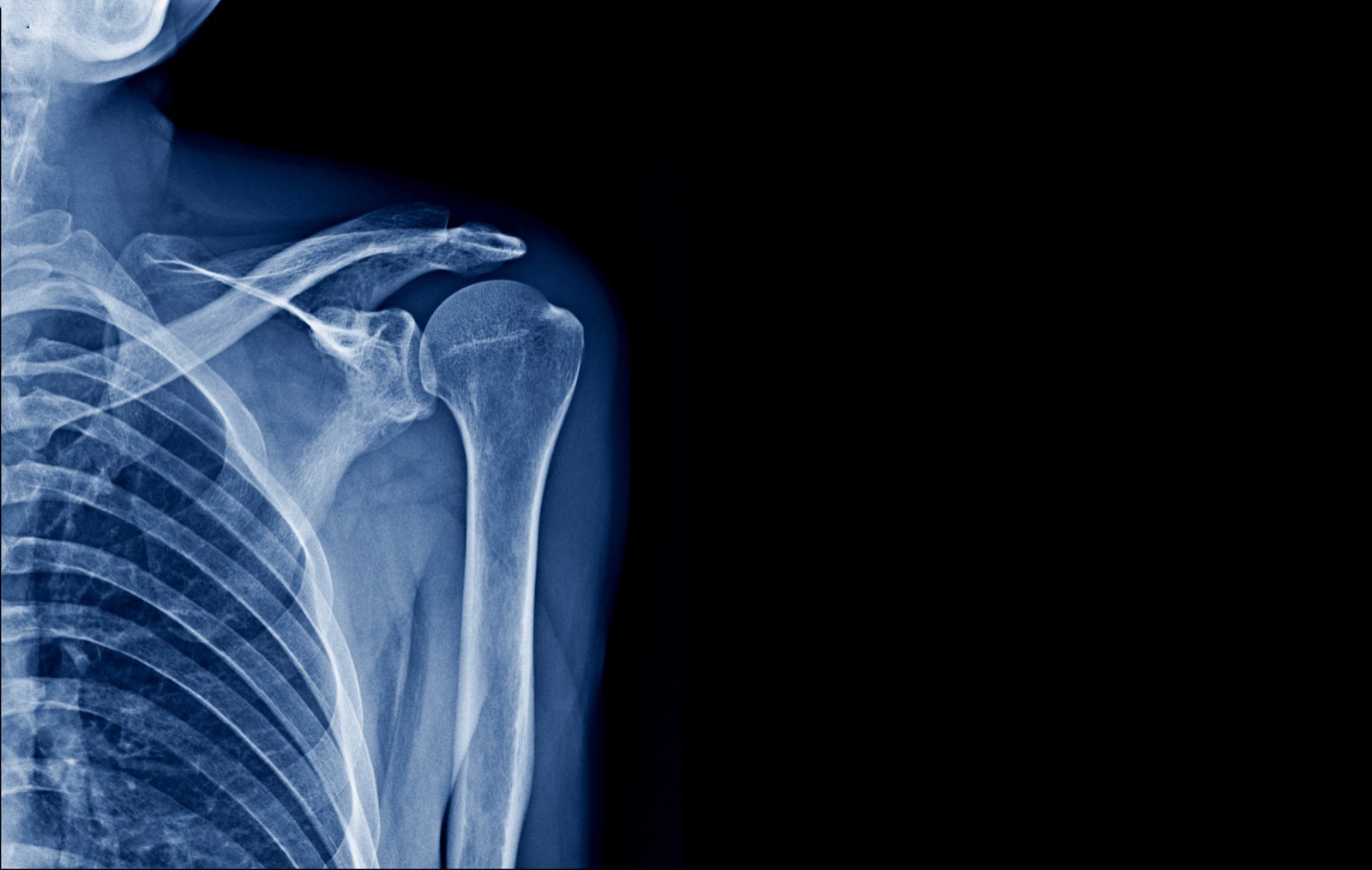 AC Joint Injury diagnosis