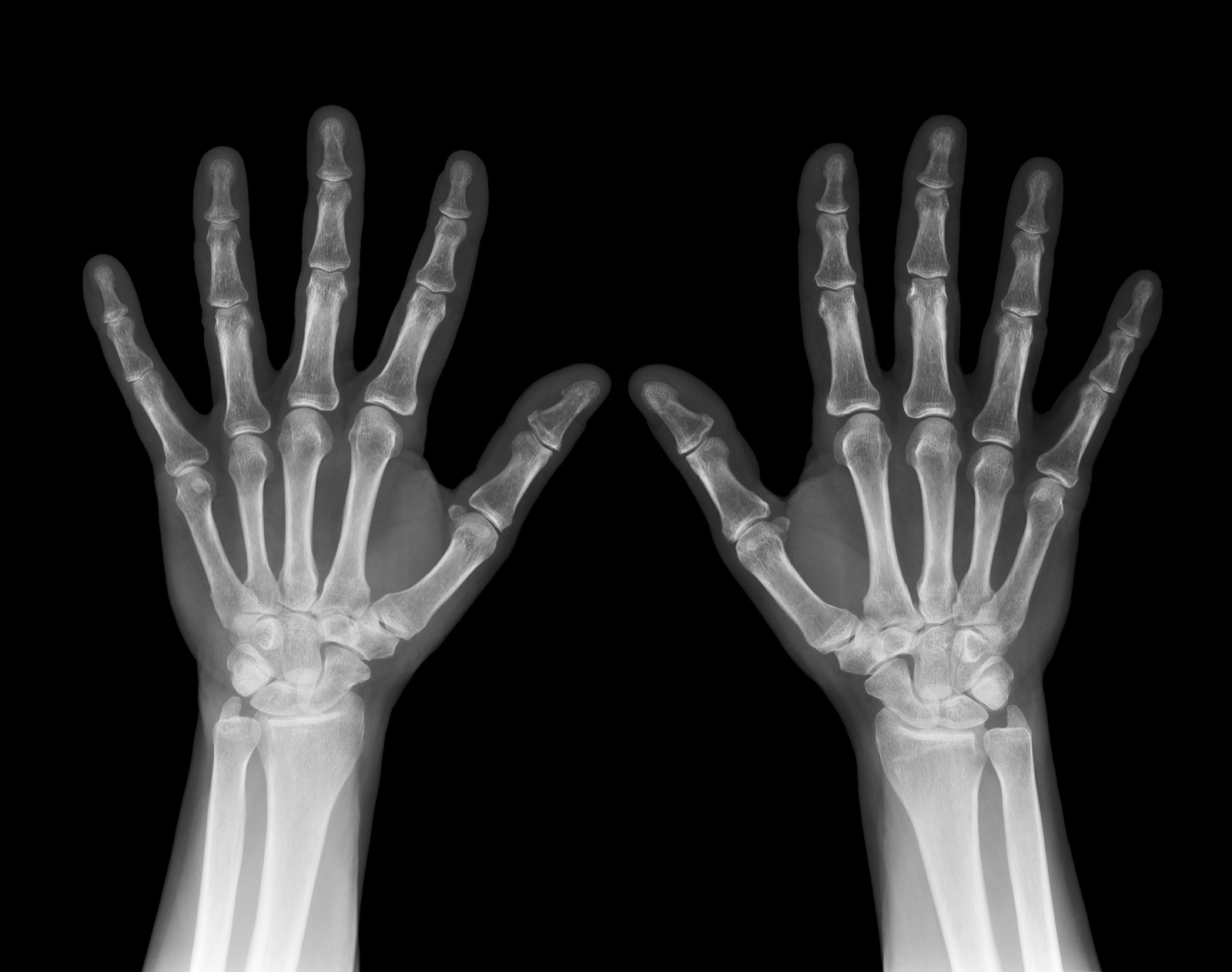 Broken Wrist